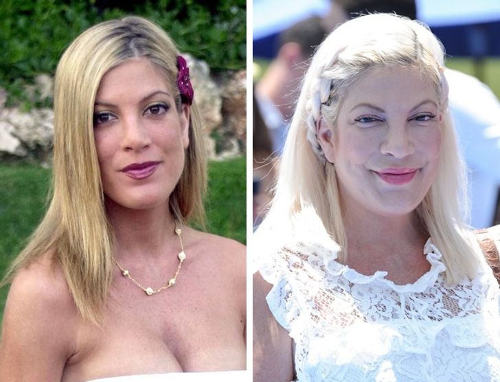 hiressegek plasztikai mutet Tori Spelling