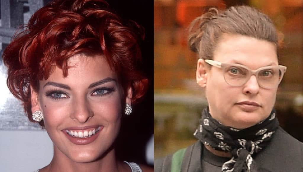Linda-Evangelista zsirleszivas beavatkozas